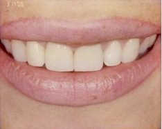 Woman smiling to replace stained and chipped bonding with Ceramic Crowns