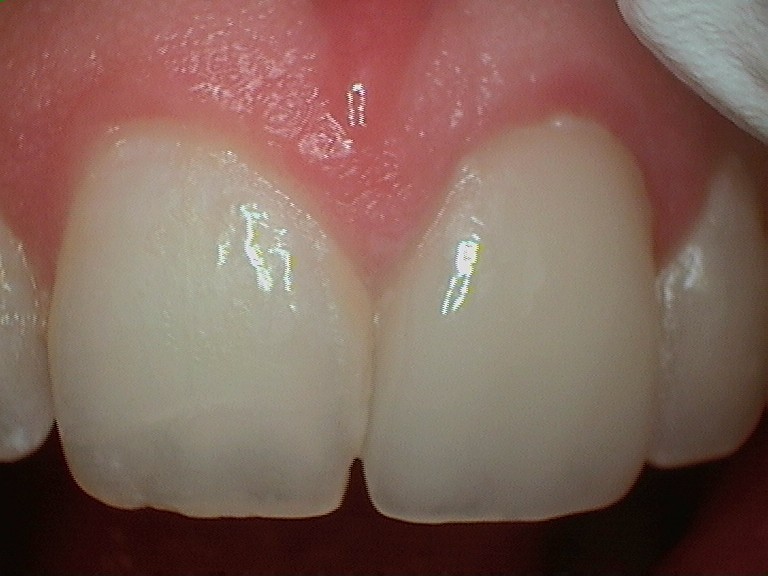 Ceramic E-max Crown on front tooth