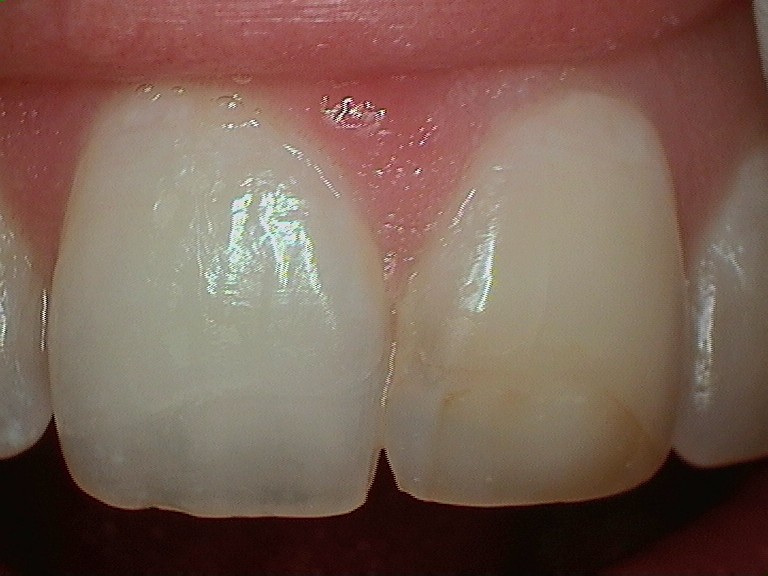 Discolored front teeth