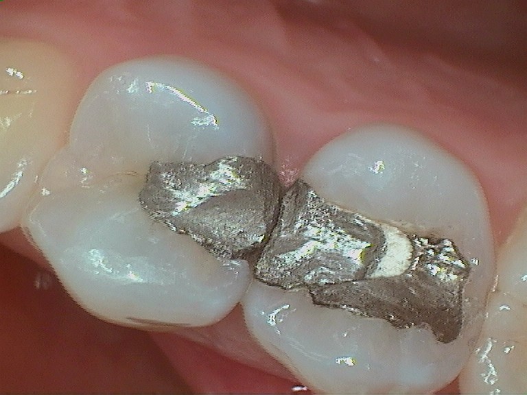 A tooth showing cracked silver fillings