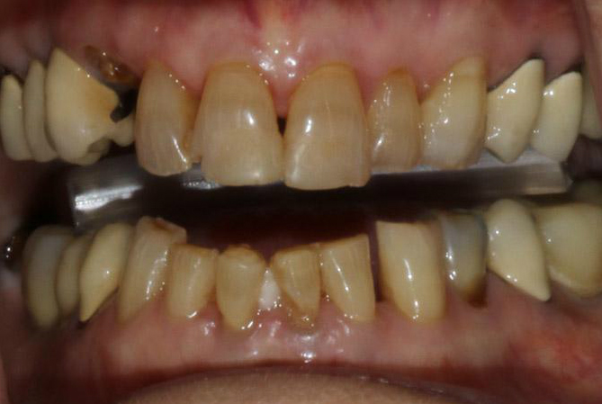 Broken and discolored teeth