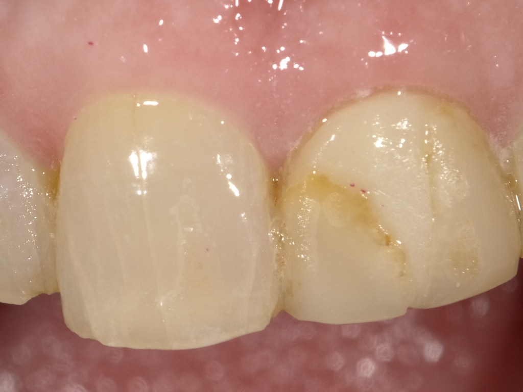 Two Discolored Front Tooth