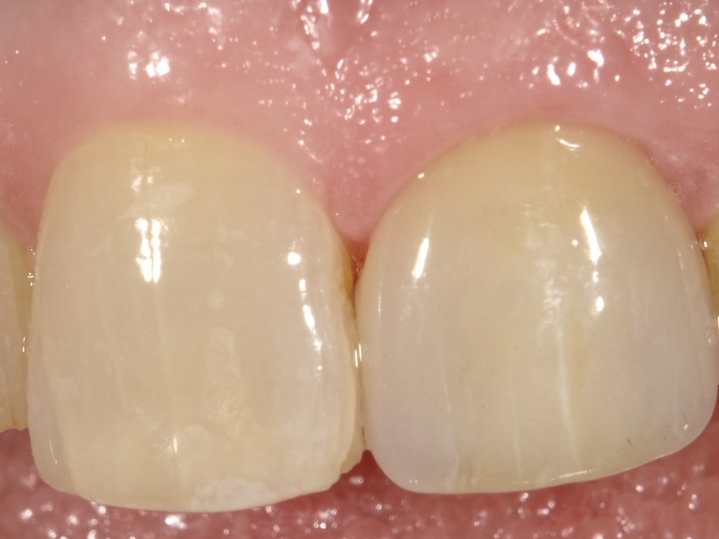A Ceramic Crown on Front Tooth