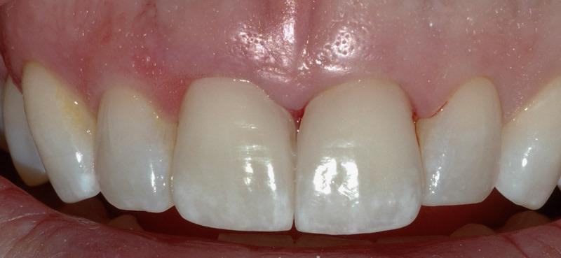 Repairing teeth with Ceramic Crowns